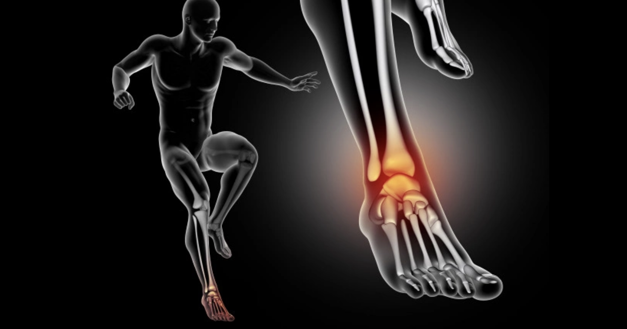 Magnetoterapia para fractura de astrágalo